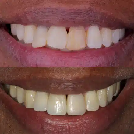 Resultado de tratamento odontológico 1