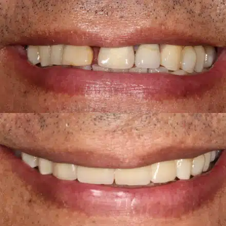 Resultado de tratamento odontológico 3